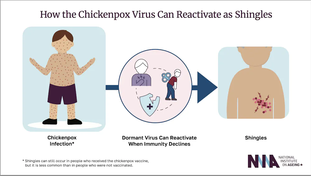Shingles Infection Control What to know about shingles, a painful infection that vaccination can ...
