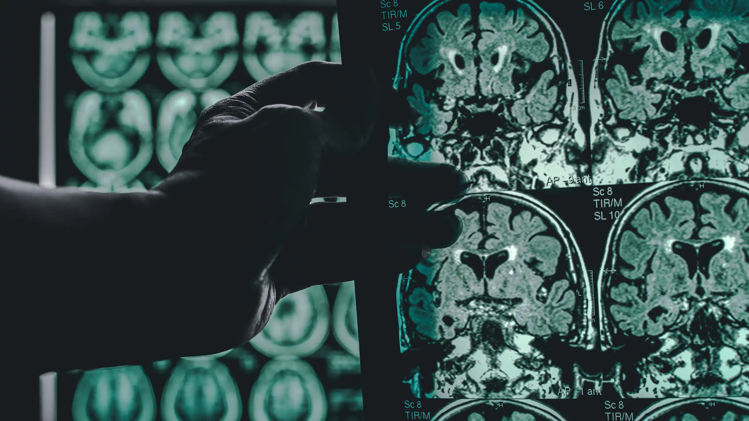 Una mà sosté unes radiografies del cervell.