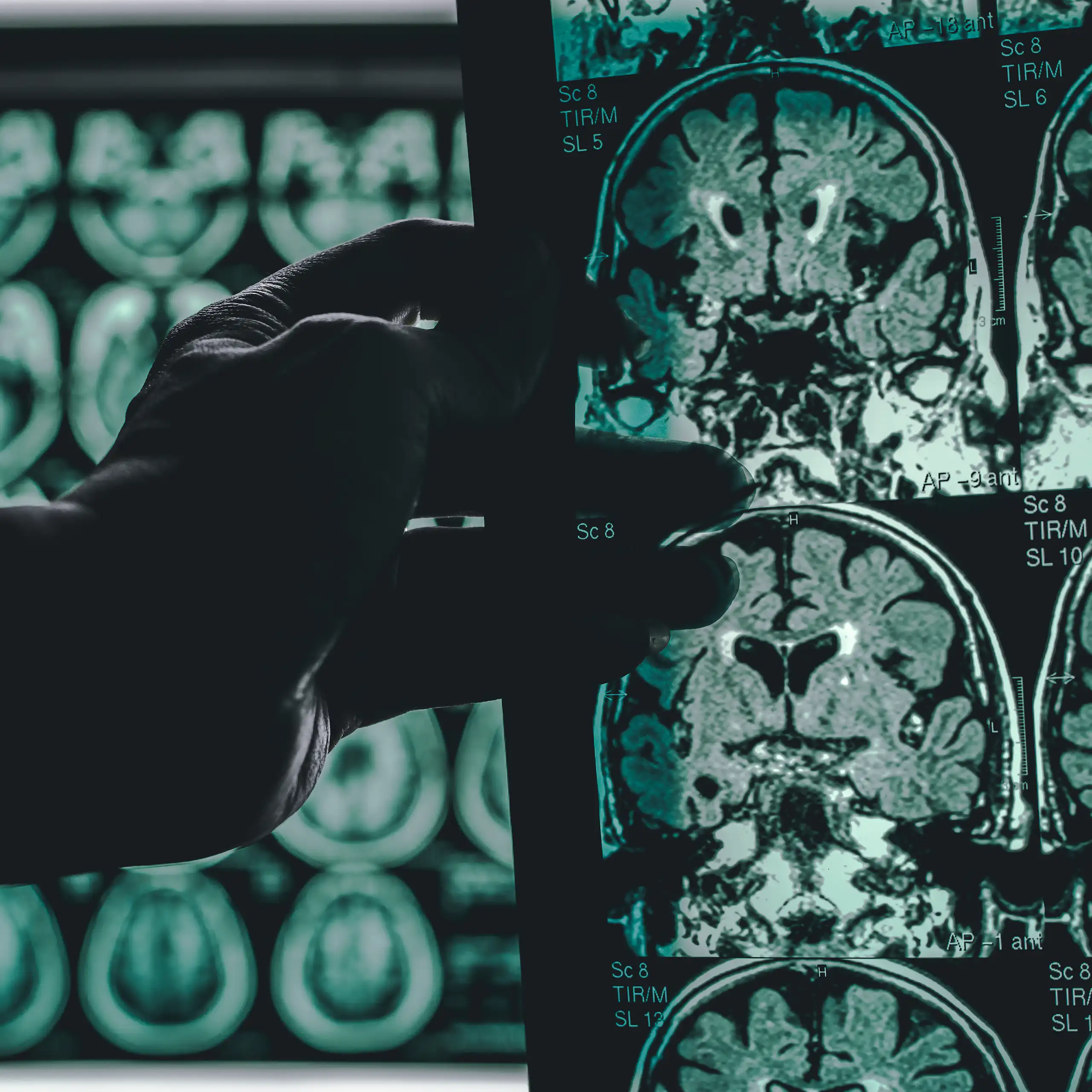 Una mà sosté unes radiografies del cervell.