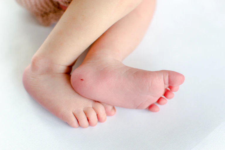 A newborn's heels with one showing a small scratch from the heel prick test.