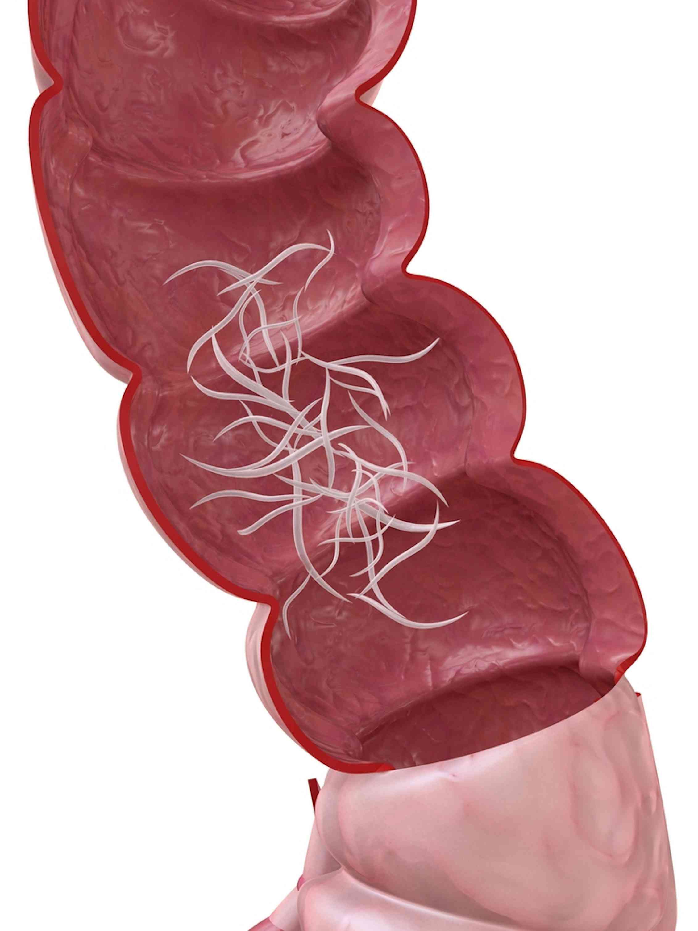 Health check: the low-down on ‘worms’ and how to get rid of them