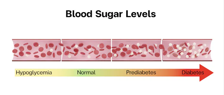 Blood sugar levels on a spectrum from hypoglycemia to diabetes.