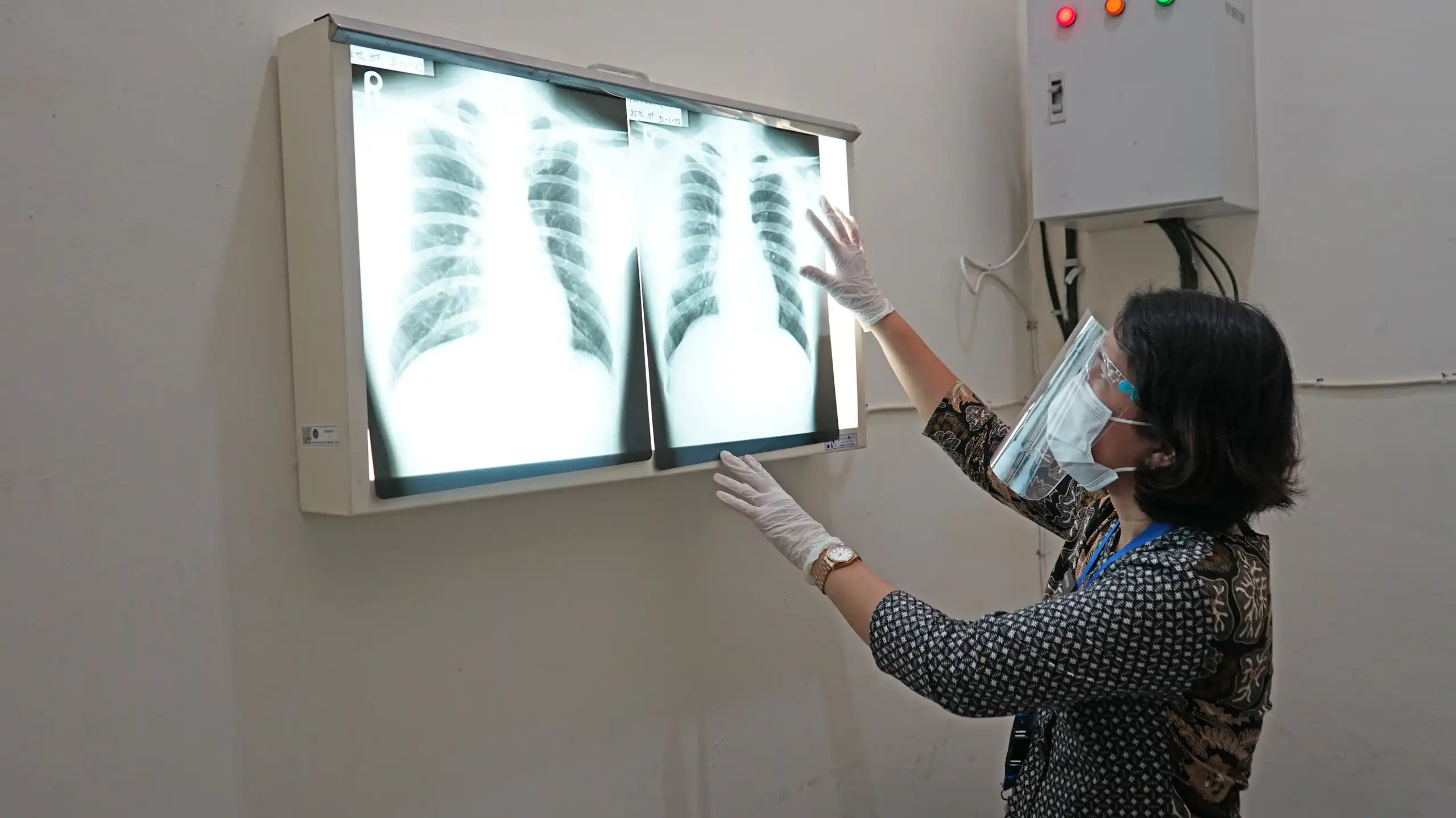 Selama ini pembacaaan hasil rontgen untuk deteksi TB di Indonesia masih mengandalkan kemampuan analisis dokter radiologi.