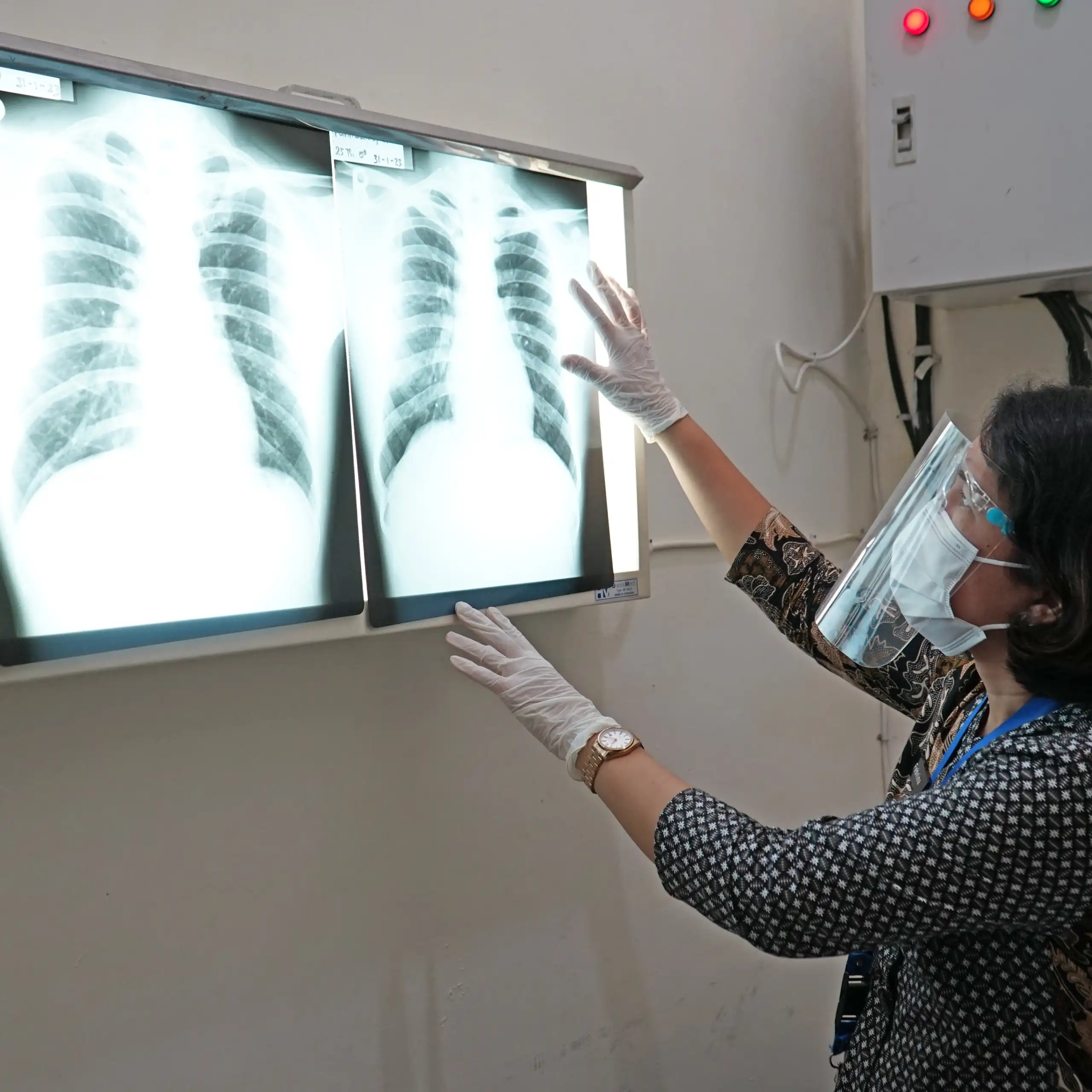 Selama ini pembacaaan hasil rontgen untuk deteksi TB di Indonesia masih mengandalkan kemampuan analisis dokter radiologi.