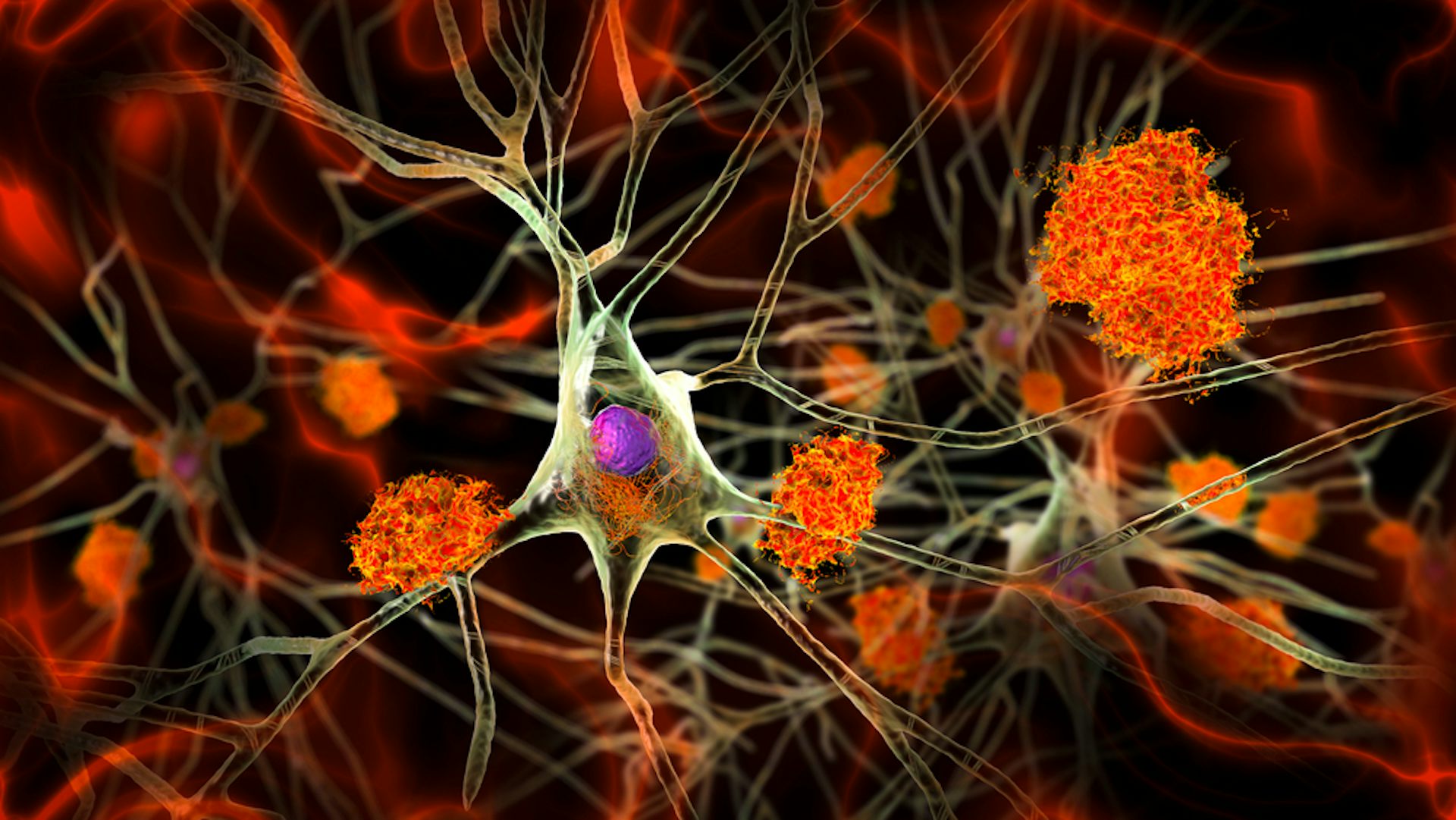 An illustration of amyloid plaques clogging up a brain's neurons.