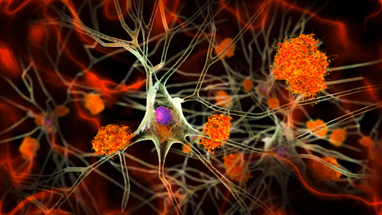 An illustration of amyloid plaques clogging up a brain's neurons.