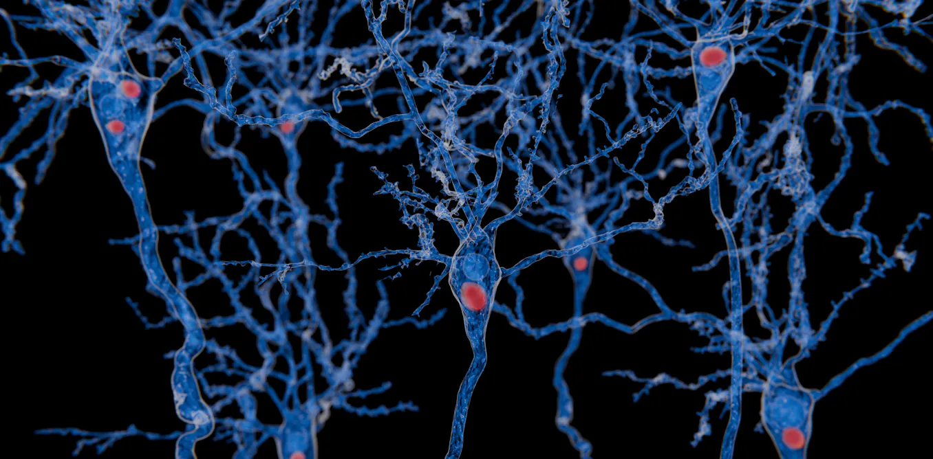Maladie à corps de Lewy : quelle est cette maladie neurocognitive fréquente, mais peu connue, qui a emporté Nathalie Baye ? Maladie à corps de Lewy : quelle est cette maladie neurocognitive fréquente, mais peu connue, qui a emporté Nathalie Baye ?