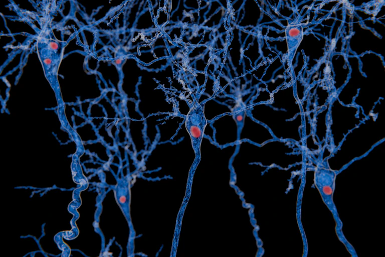 Vue d’artiste de neurones comportant des corps de Lewy ; ces amas protéiques, qui perturbent le fonctionnement neuronal, sont caractéristiques de la maladie à corps de Lewy.
