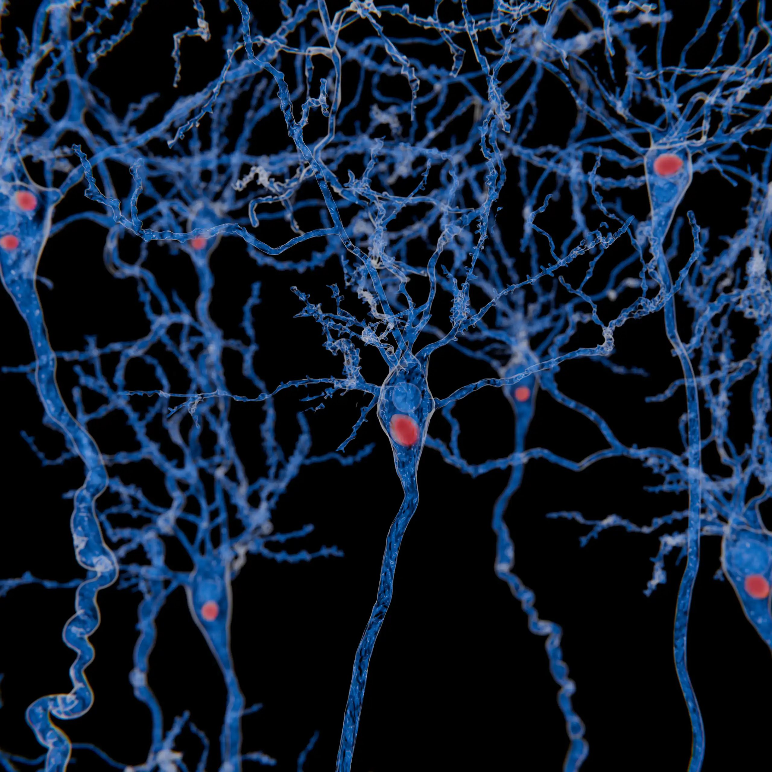 Vue d’artiste de neurones comportant des corps de Lewy ; ces amas protéiques, qui perturbent le fonctionnement neuronal, sont caractéristiques de la maladie à corps de Lewy.