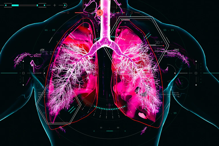 3D image of chronic obstructive pulmonary disorder