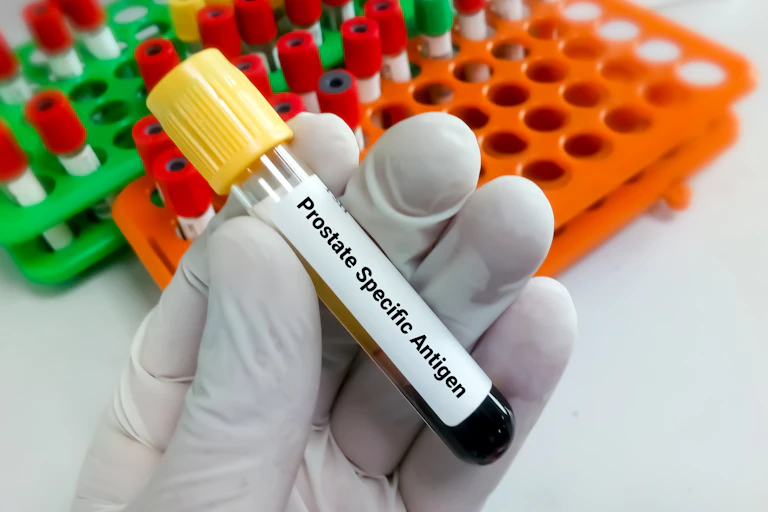 A person wearing white surgical gloves holds a vial of blood, which is labelled "Prostate Specific Antigen."