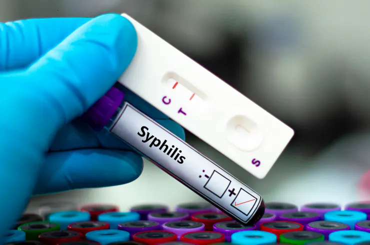Gloved hand holding a vial labeled Syphilis with a test result next to it.