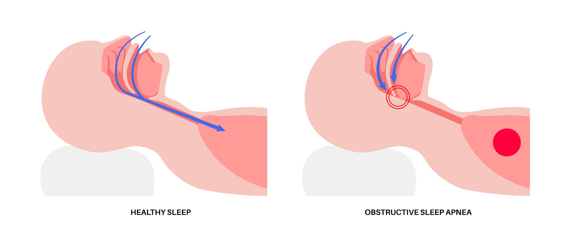 Graphic illustration of obstructive sleep apnea with obstructed sleep on the left and an obstructed airway on the right.