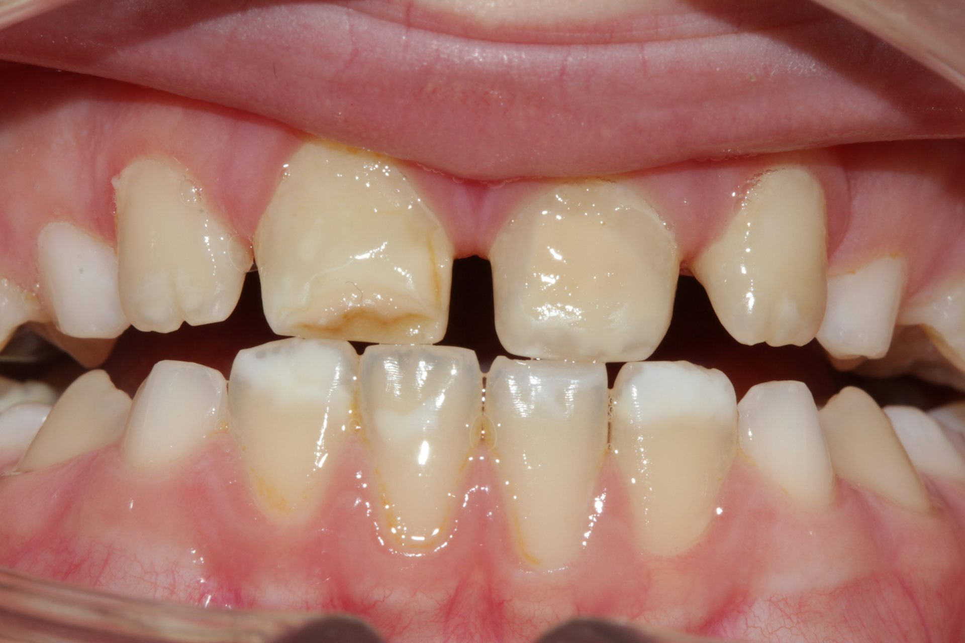 Manchas en los dientes: ¿por qué tantos niños las tienen?