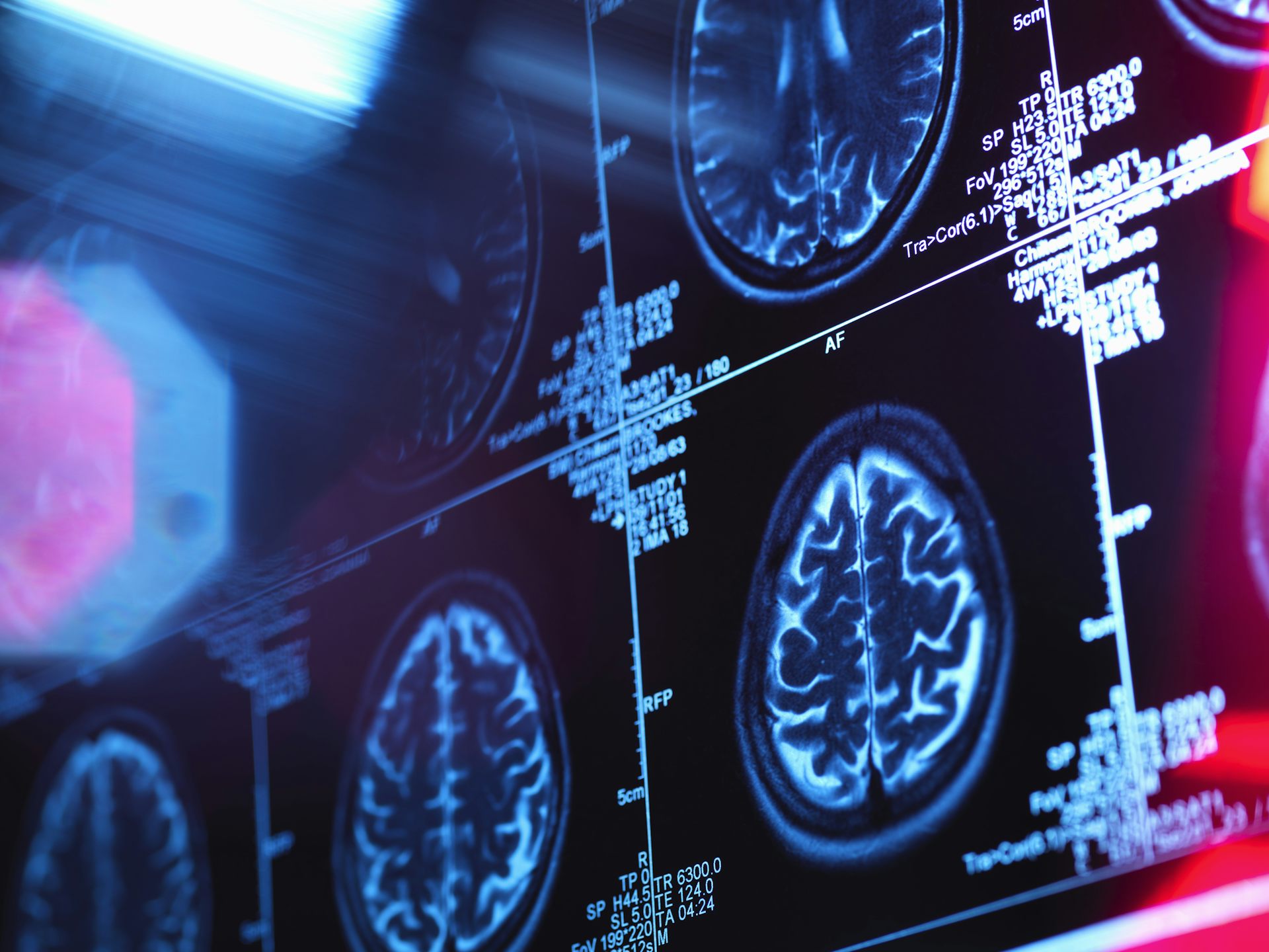 Blood biomarkers could detect earliest signs of Alzheimer’s disease – and slow its progression