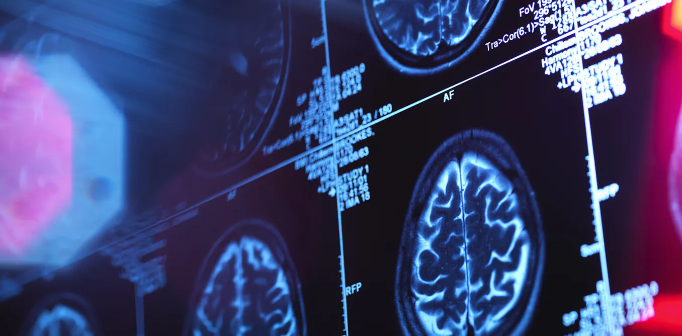 Biomarkerii sanguini ar putea detecta cele mai timpurii semne ale bolii Alzheimer și încetini progresia acesteia