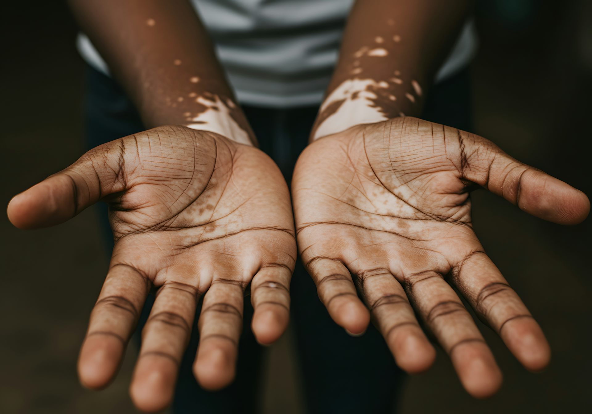 A person with vitiligo shows off the palms of their hands and arms, where white patches have appeared.