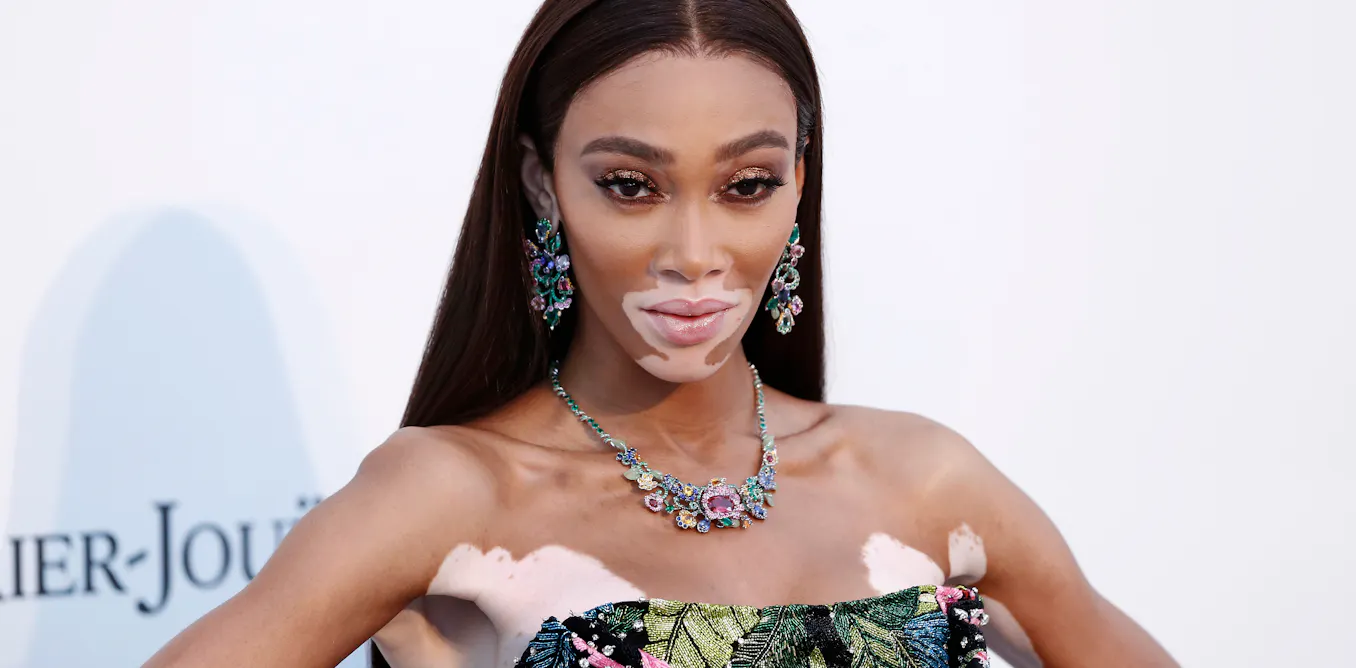EduWireDaily — Vitiligo affects around 1 in 100 people worldwide – yet the skin condition remains misunderstood