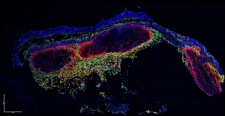 Cells in green and yellow forming a boundary around a purplish lump