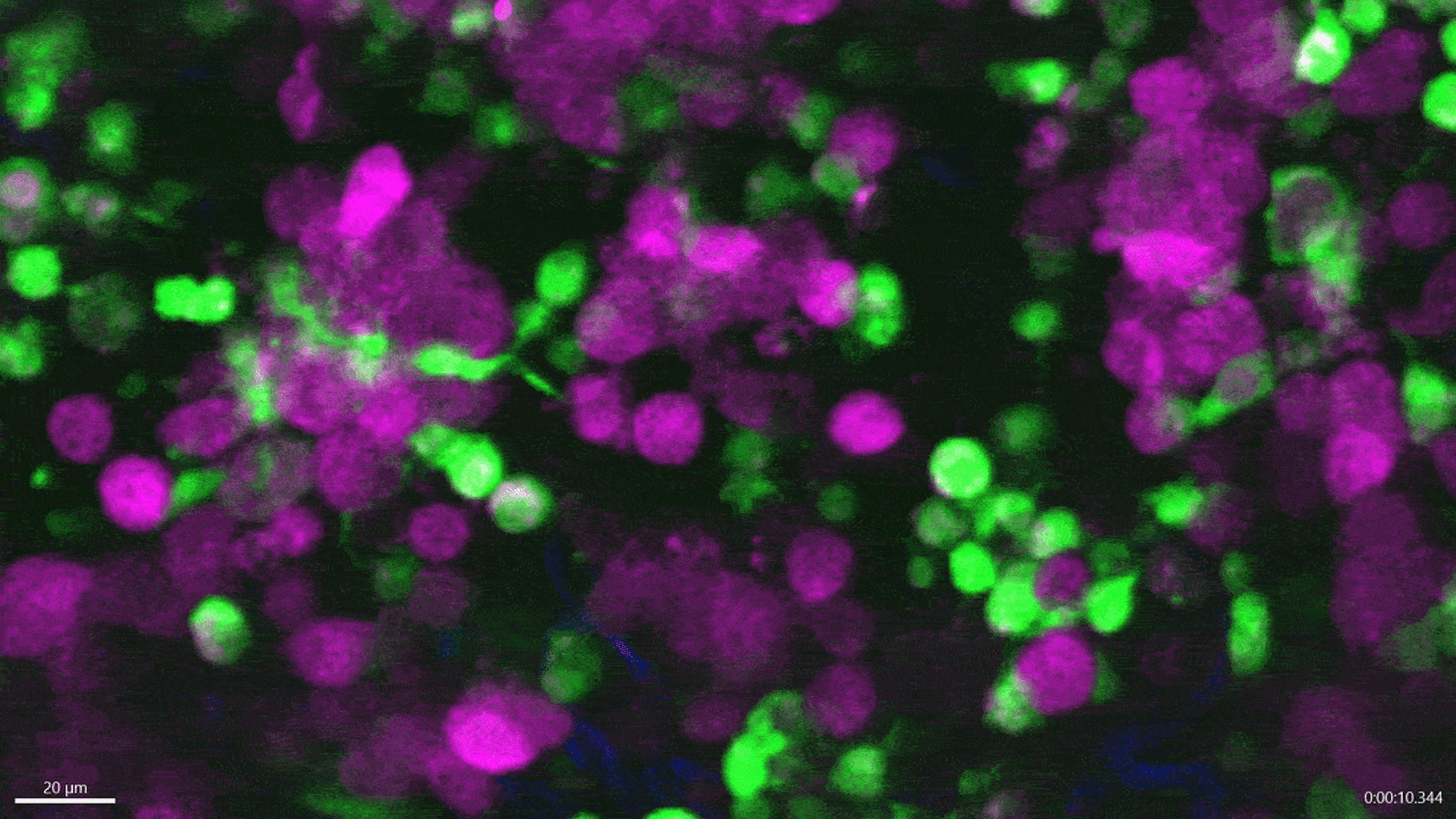 First video of immune cells eating live skin cancer in real time