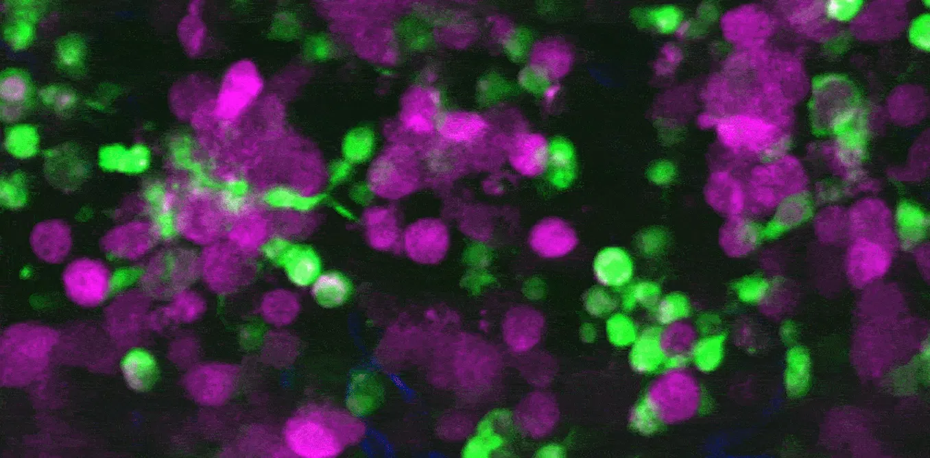 First video of immune cells eating live skin cancer in real time