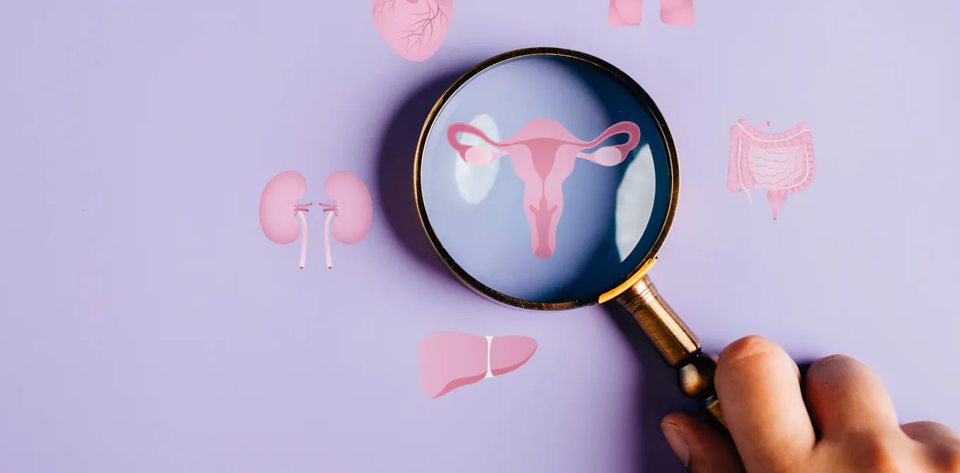 I’m a doctor who helped rename PCOS to PMOS – a 10-year process of listening to 14,000 patients and health professionals speak on how to improve care