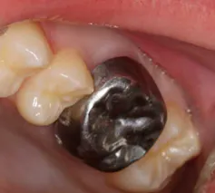 Molar incisor hypomineralization, a poorly understood dental anomaly affecting thousands and thousands of kids 4 file 20260602 57 llnutx.png?ixlib=rb 4.1