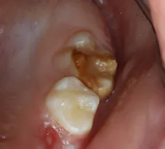 Molar incisor hypomineralization, a poorly understood dental anomaly affecting thousands and thousands of kids 3 file 20260602 57 i2gmxx.png?ixlib=rb 4.1