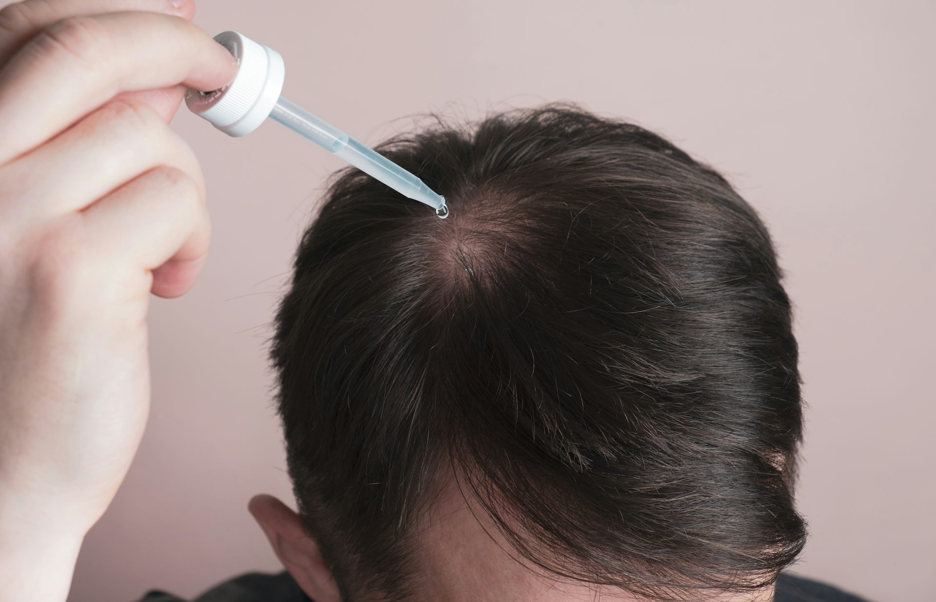A man applies liquid minoxidil with a dropper to a bald spot in his hair.