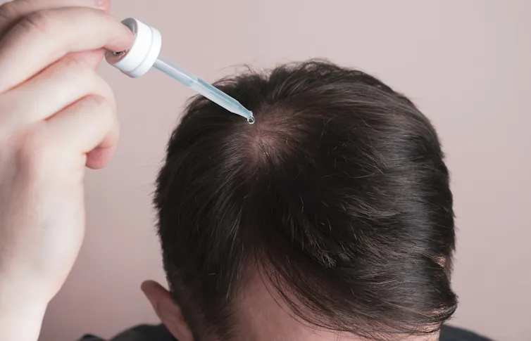 A man applies liquid minoxidil with a dropper to a bald spot in his hair.