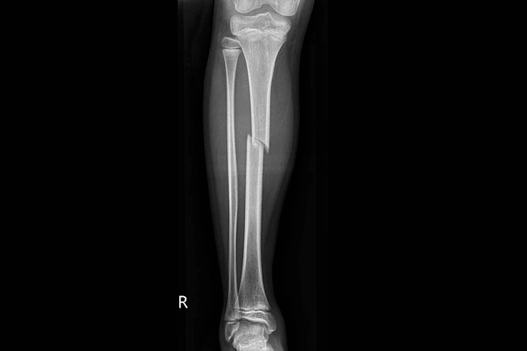 X-ray of a broken leg.