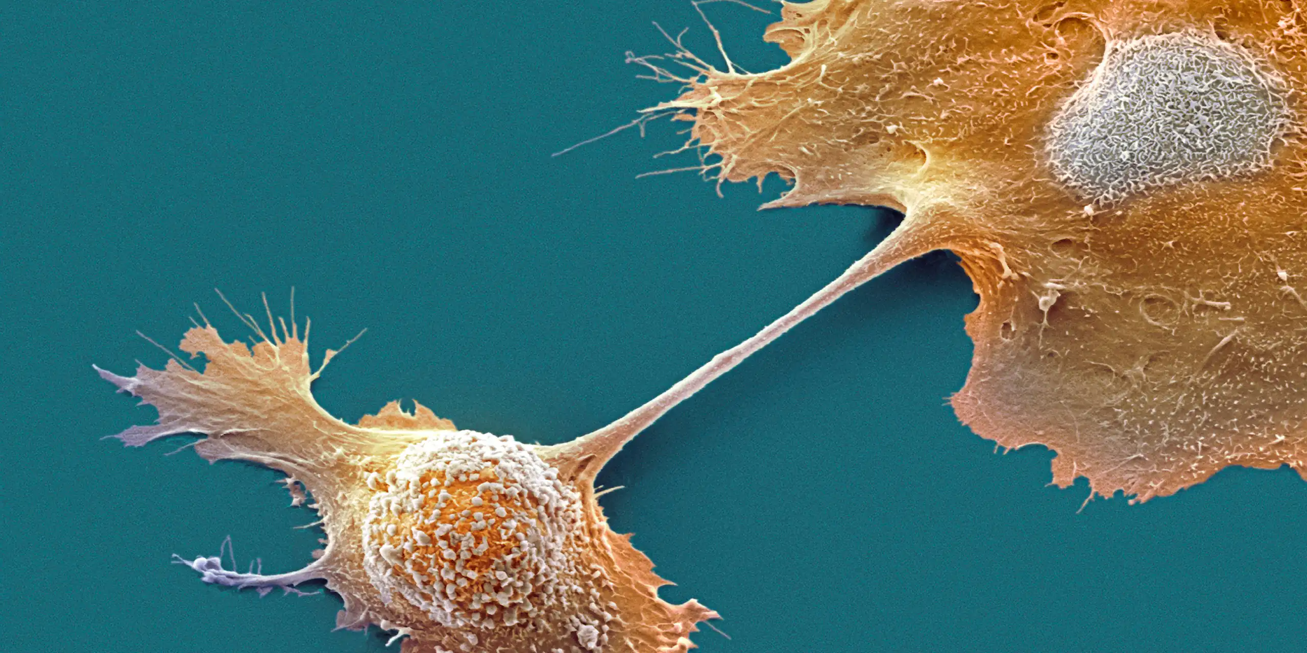 Micrographie électronique (fausses couleurs) de deux cellules de tumeur du pancréas.