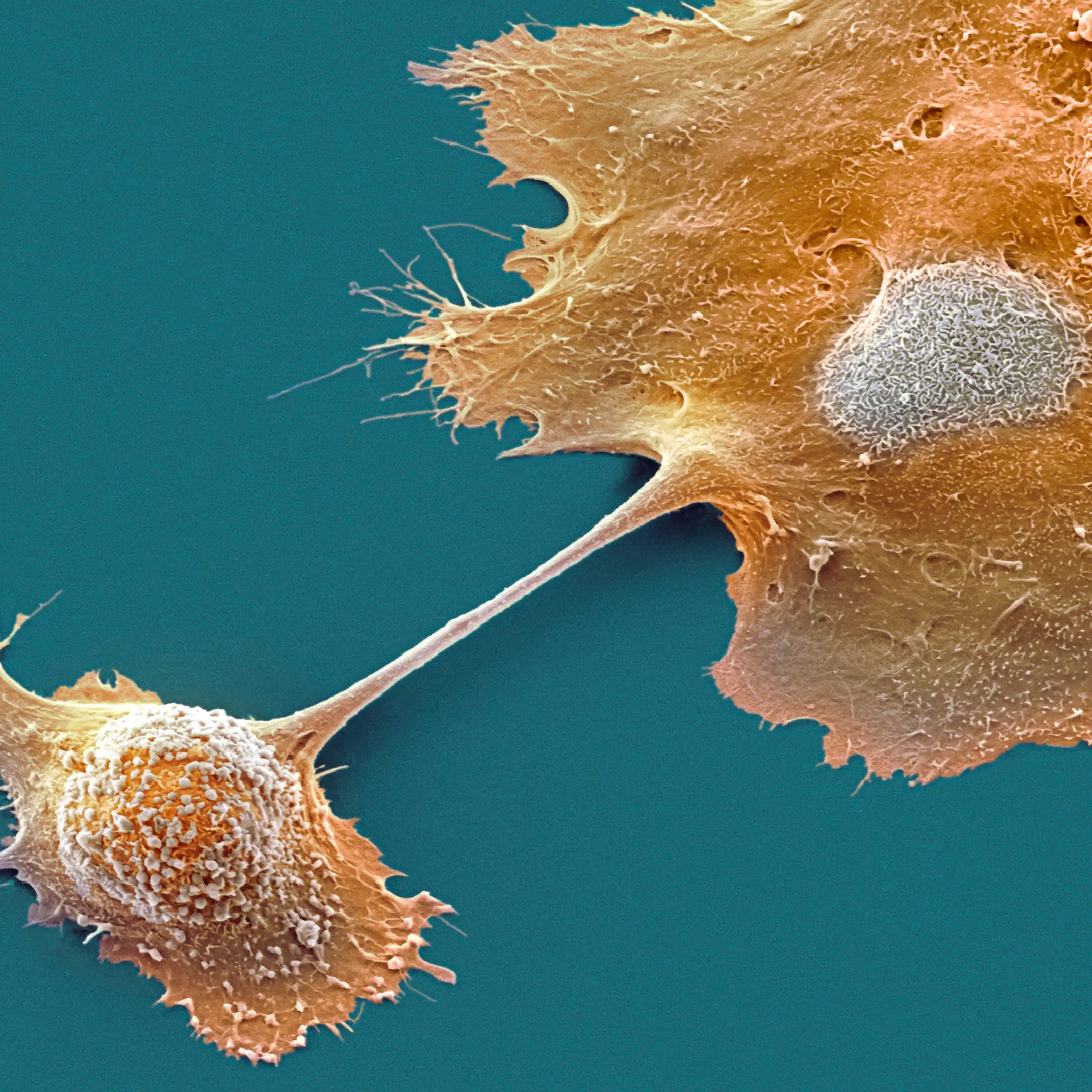 Micrographie électronique (fausses couleurs) de deux cellules de tumeur du pancréas.