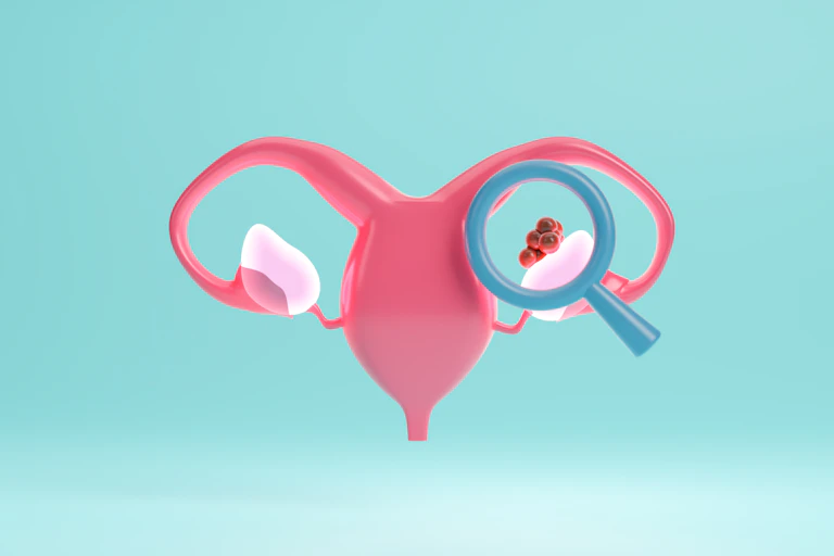 A drawing depicting the female reproductive system. A magnifying glass has focused on the ovary, which has a red tumour or growth on it.