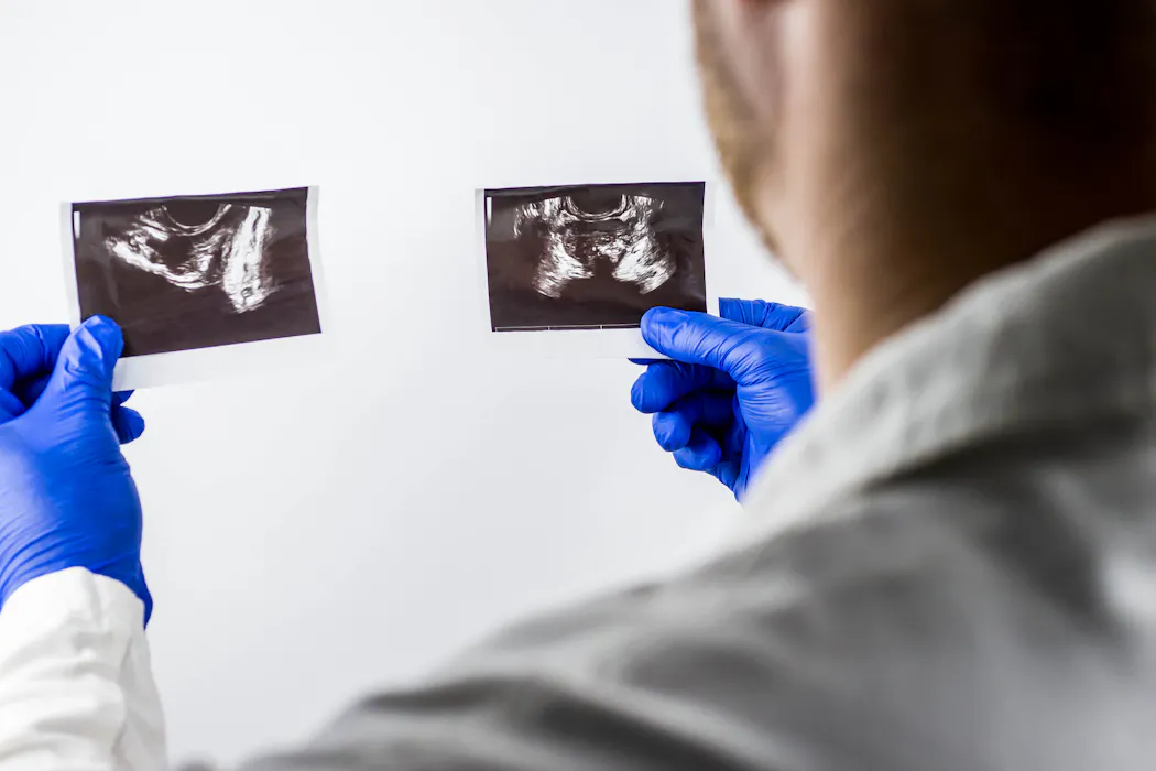 Why some men with prostate cancer may soon need only five radiotherapy sessions