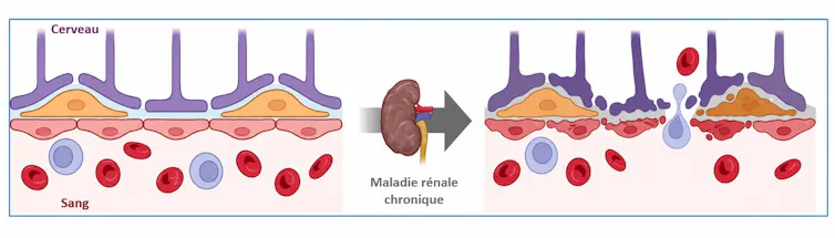 Kidney illness may be a mind illness 1 A simplified diagram of the changes in the blood-brain barrier that occur during kidney disease