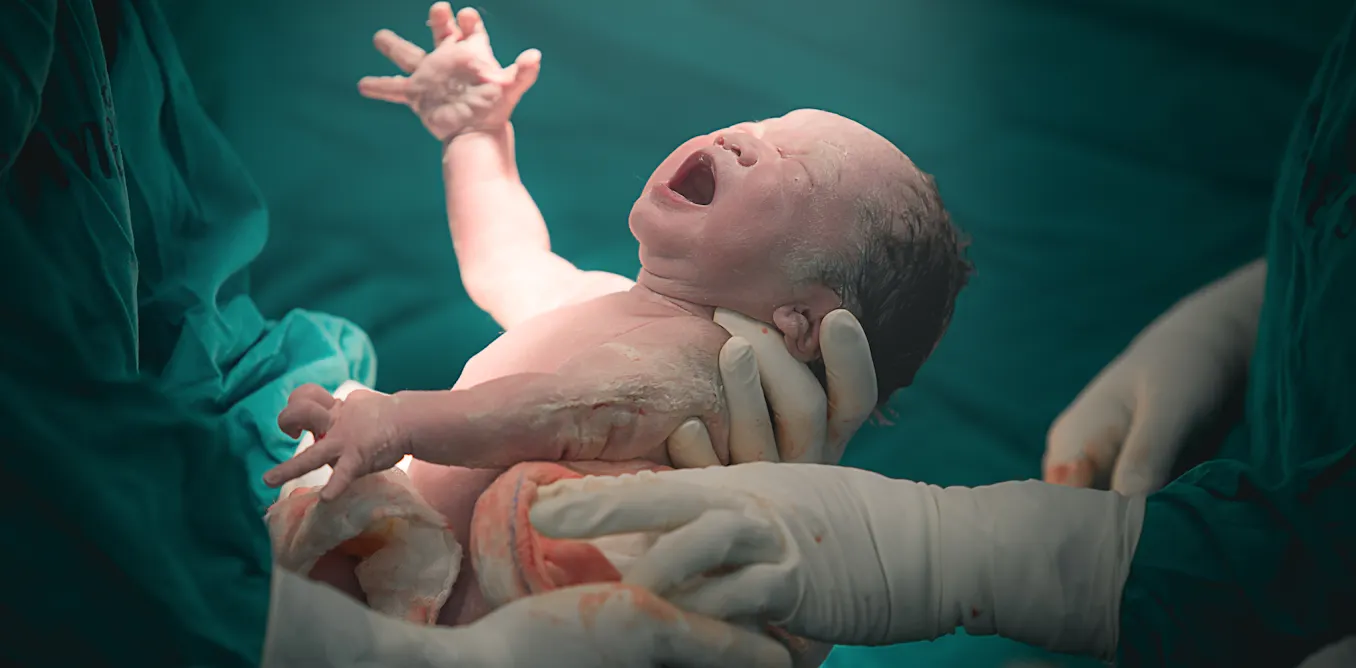 EduWireDaily — Why more births now end in caesarean section