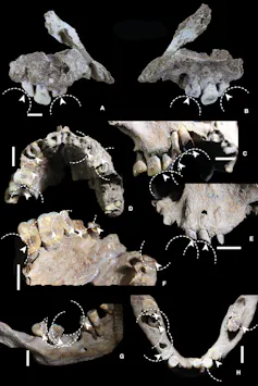 Images of jawbones and teeth