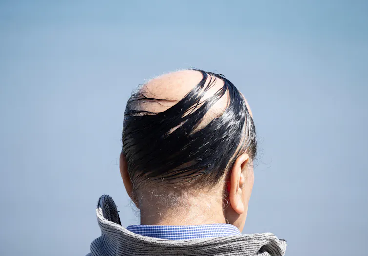 A man with a bad combover.