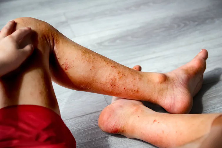 Cropped image of child's legs with atopic dermatitis