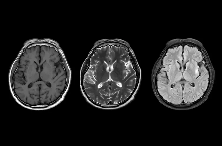 Three greyscale MRI scans of the brain.