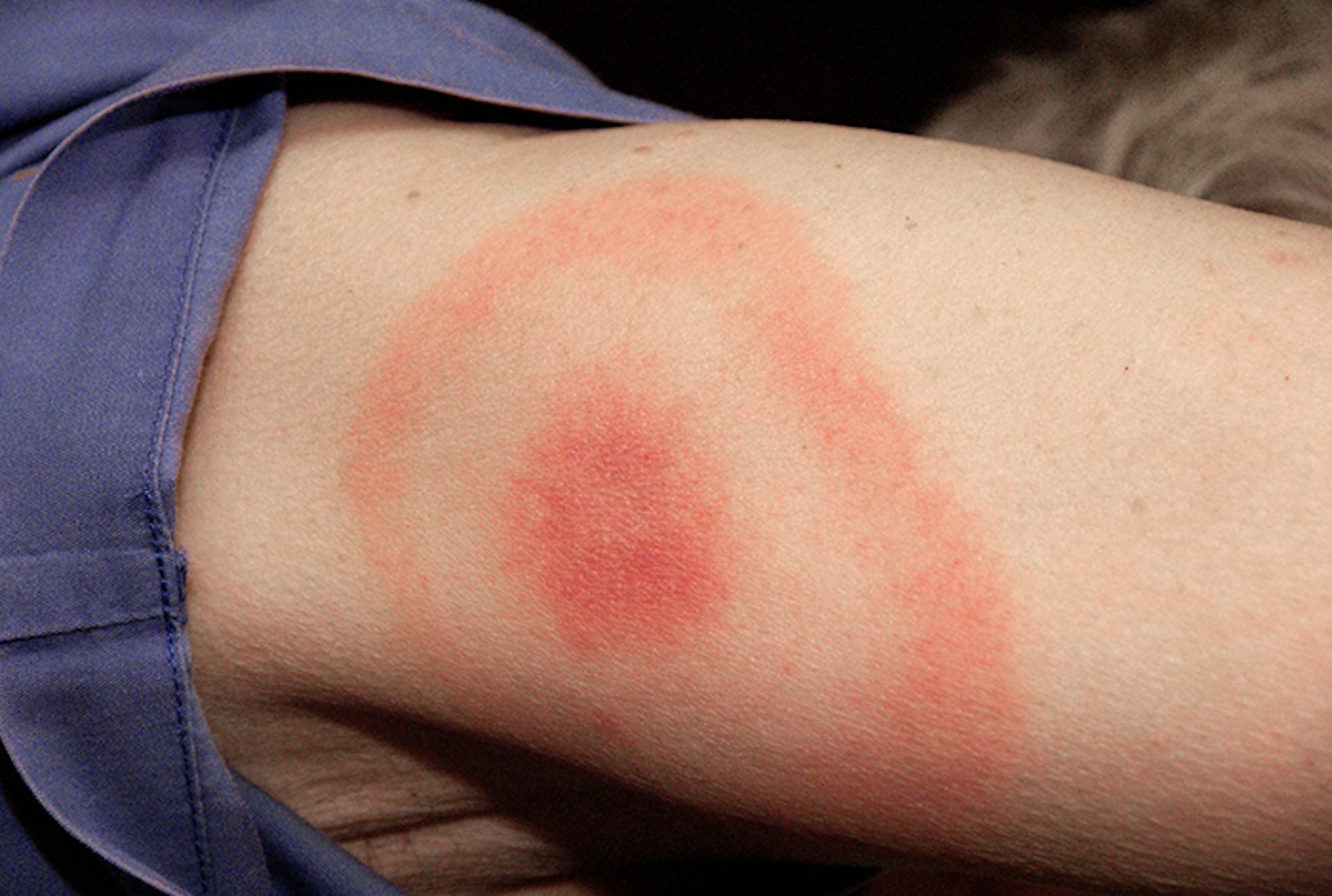 A woman's arm has a rash in the shape of a bulls-eye, with a large red spot and ring surrounding it.