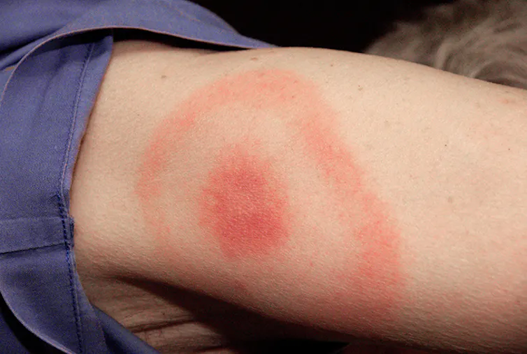 A woman's arm has a rash in the shape of a bulls-eye, with a large red spot and ring surrounding it.
