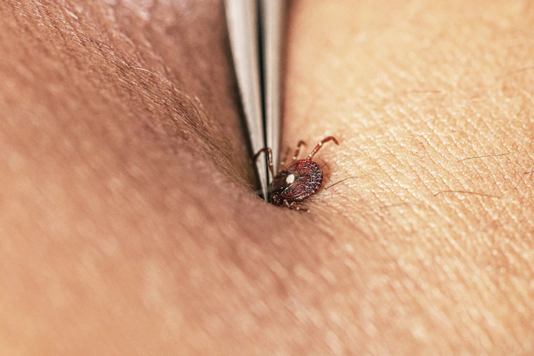A person uses tweezers to pull a tick out of skin.
