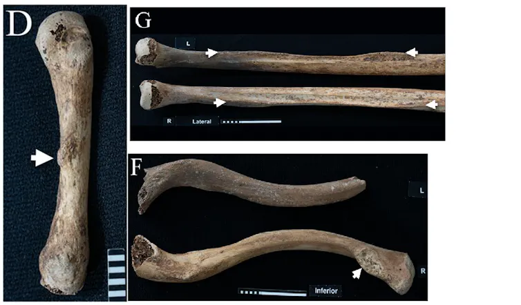 Bilder von Finger-, Arm- und Schlüsselbeinknochen.