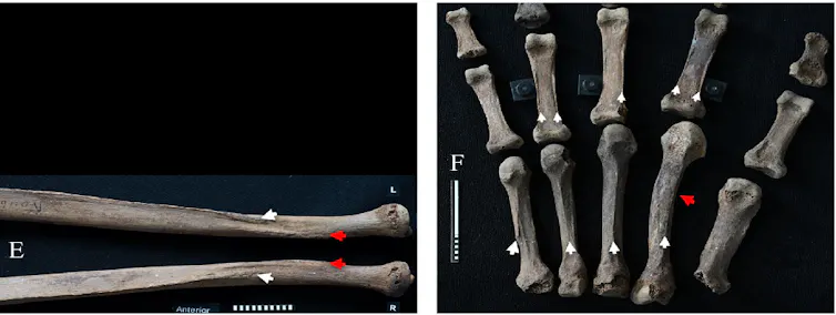 Bilder von Knochen von Armen und Händen.