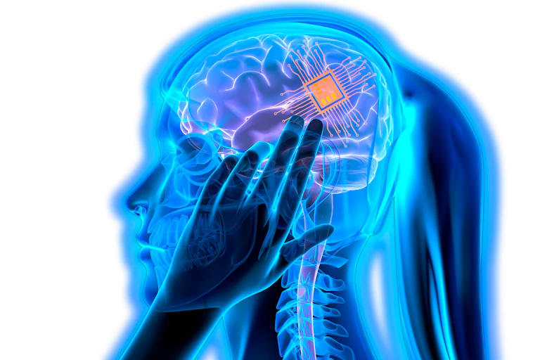 Radiografía del cerebro de una chica en la que se ve un implante