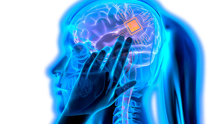 Radiografía del cerebro de una chica en la que se ve un implante