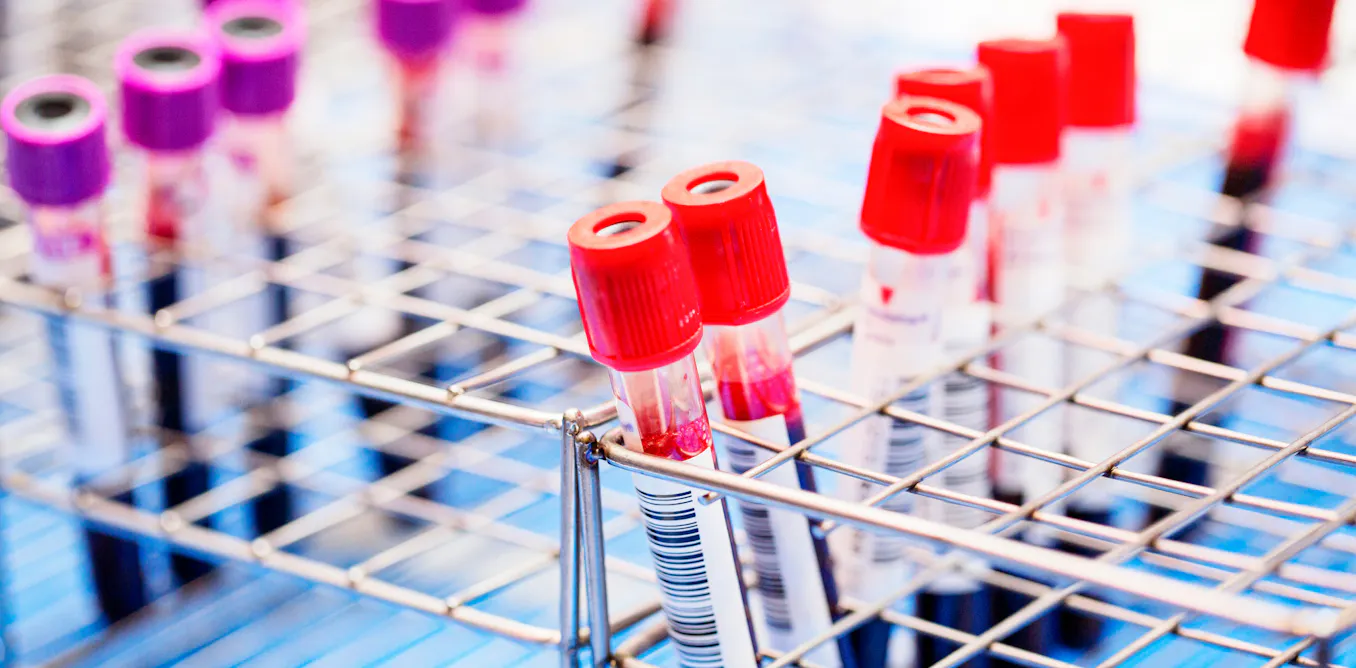 EduWireDaily — There are new blood tests for Alzheimer’s. Should I have one?