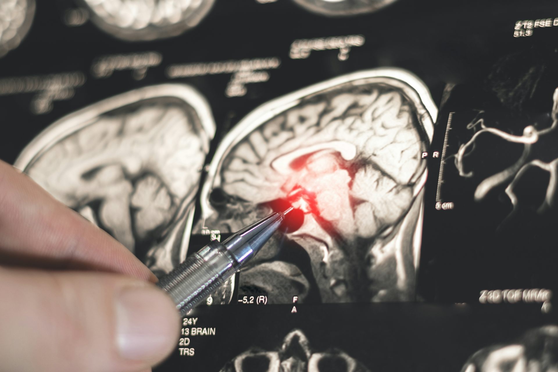 La epilepsia es más común en países de bajos ingresos